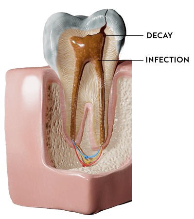 Medical diagram of an infected tooth which needs root canal therapy