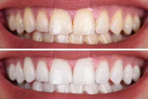 Comparison image of teeth before and after teeth whitening