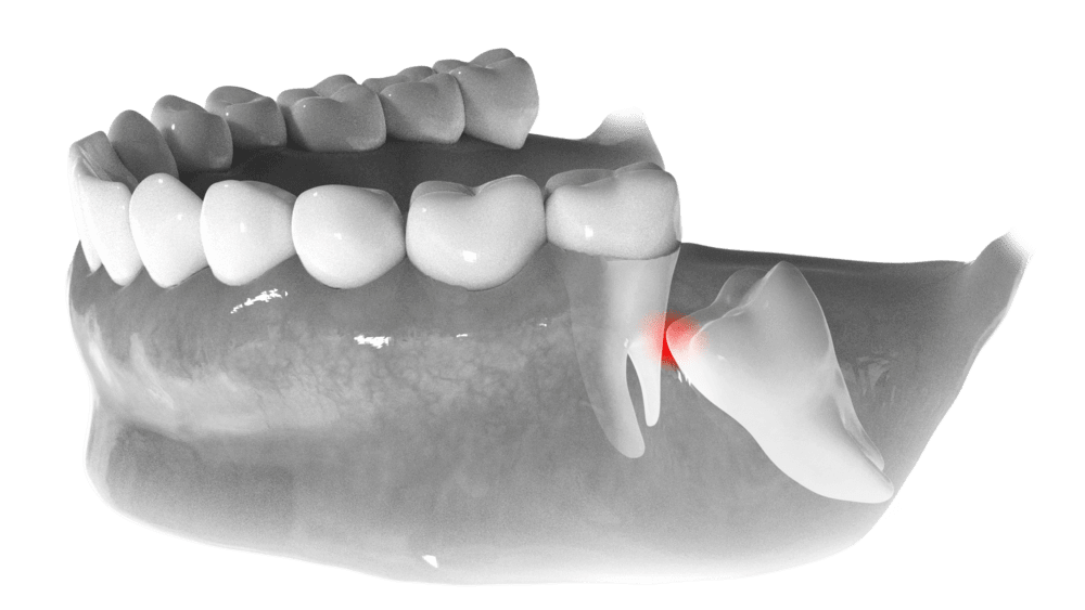 Black and white image showing a wisdom tooth interfering with another tooth