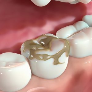 Image depicting bacteria buildup on a tooth