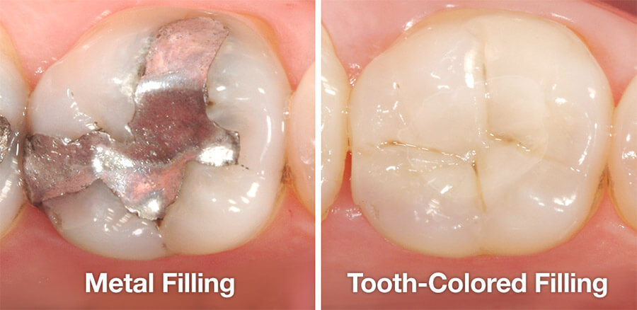 Comparison image between metal fillings and composite fillings