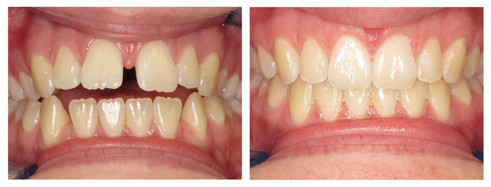 Comparison image of teeth before and after invisalign
