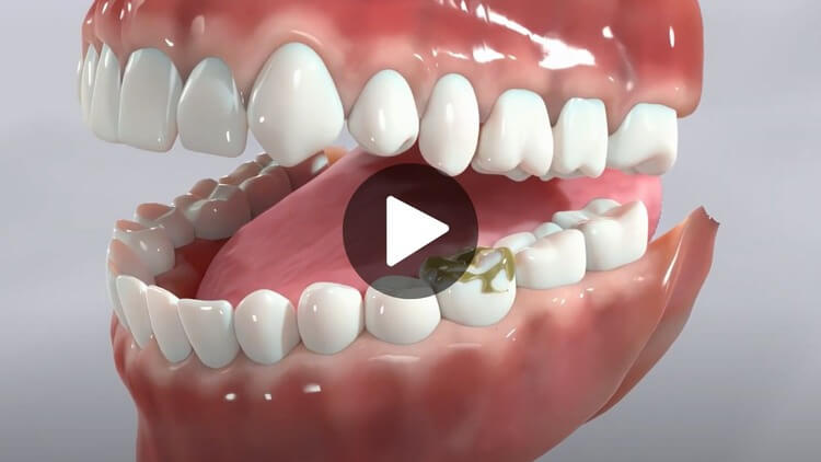 Thumbnail image for an educational video on cavities