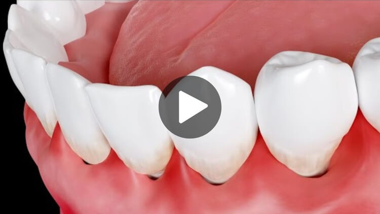 Thumbnail image for an educational video on swollen gums